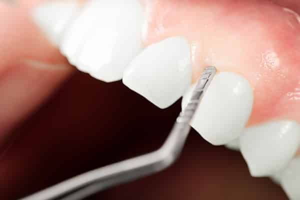 Parodontologie Behandlung Parodontitis